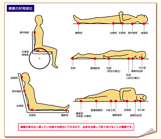 基礎から実践まで分かる 褥瘡ケア 第一回基礎編 褥瘡を理解する 評価する ナースの星 医療従事者 看護師向けのお役立ち情報サイト